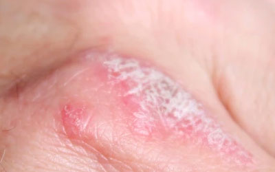 牛皮癣的类型及症状？脓疱型牛皮癣的症状？