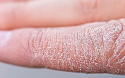 秋冬牛皮癣高发，哪些症状说明患上了银屑病？有这4个症状要小心