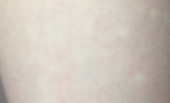腿上出现白癜风能不能根治？