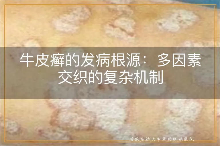 牛皮癣的发病根源：多因素交织的复杂机制
