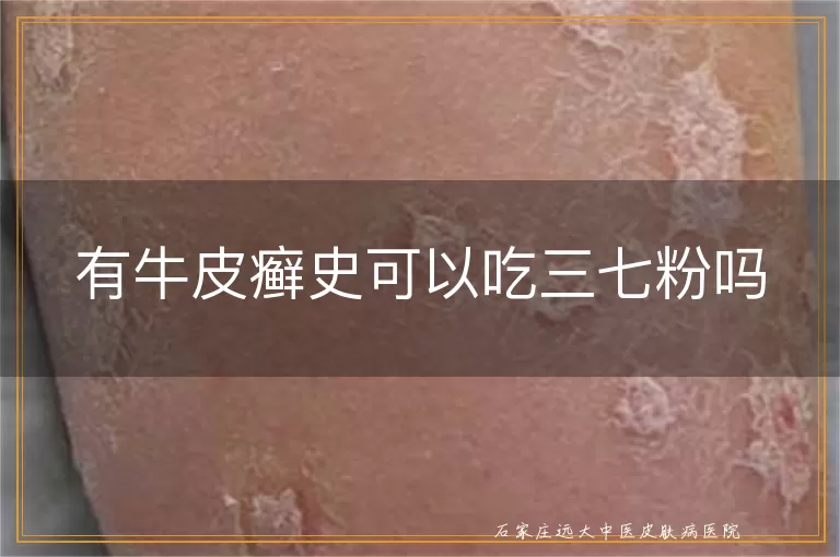 有牛皮癣史可以吃三七粉吗