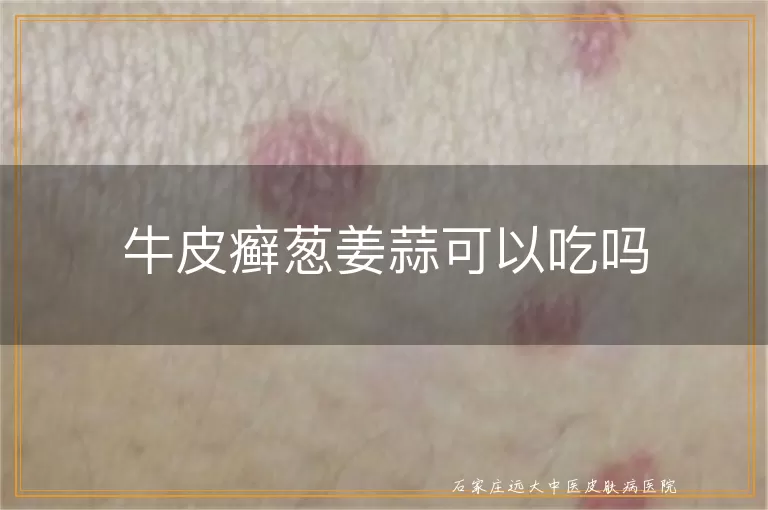 牛皮癣葱姜蒜可以吃吗