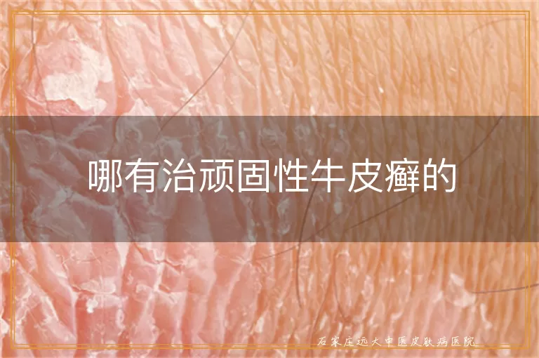 哪有治顽固性牛皮癣的