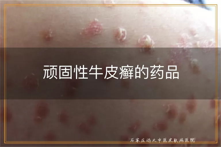 顽固性牛皮癣的药品