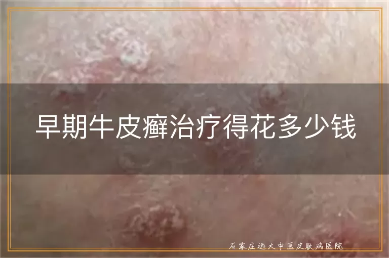 早期牛皮癣治疗得花多少钱