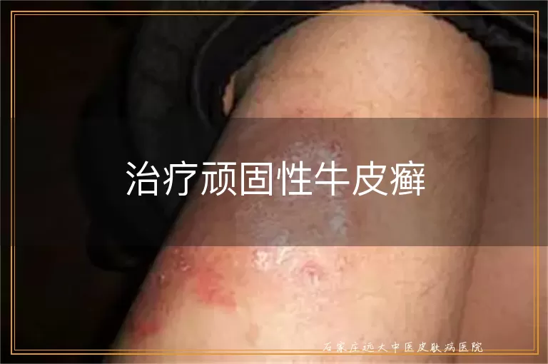 治疗顽固性牛皮癣