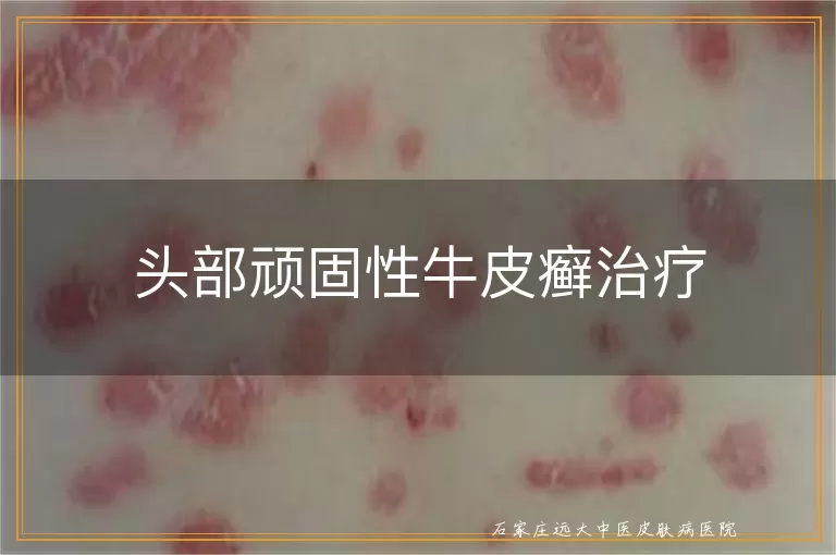 头部顽固性牛皮癣治疗