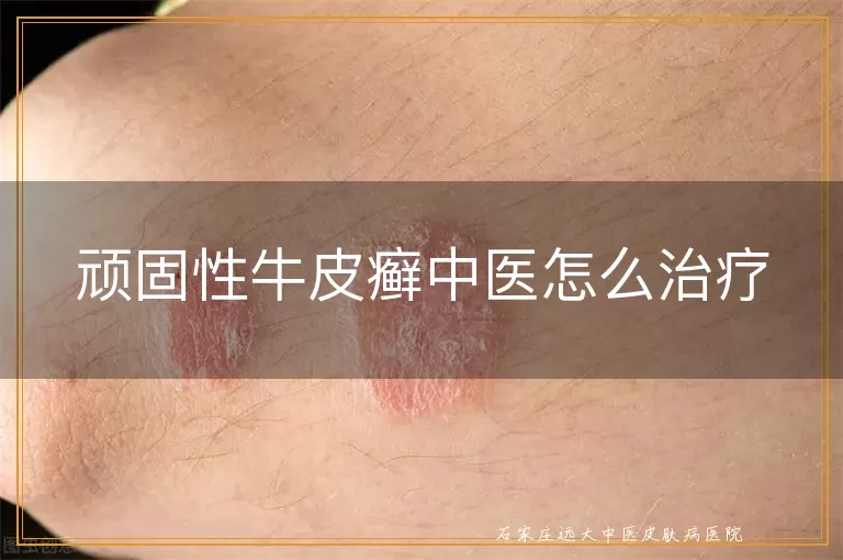 顽固性牛皮癣中医怎么治疗