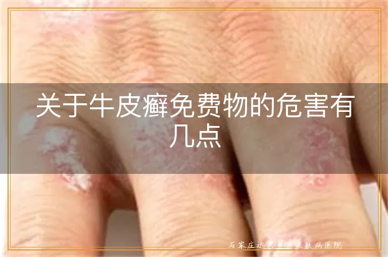 关于牛皮癣免费物的危害有几点
