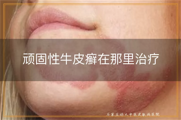 顽固性牛皮癣在那里治疗