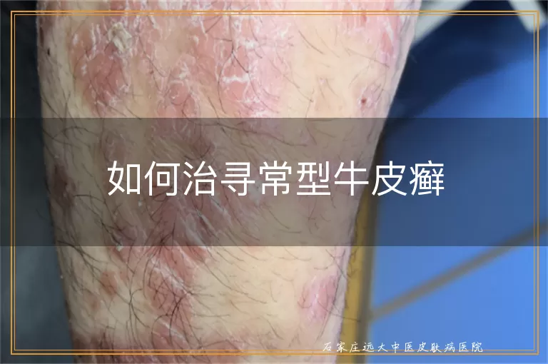 如何治寻常型牛皮癣