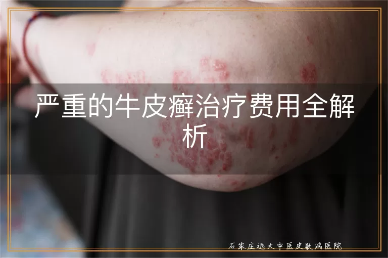 严重的牛皮癣治疗费用全解析
