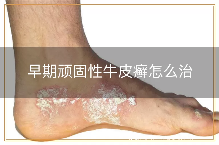 早期顽固性牛皮癣怎么治