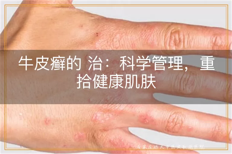 牛皮癣的 治：科学管理，重拾健康肌肤