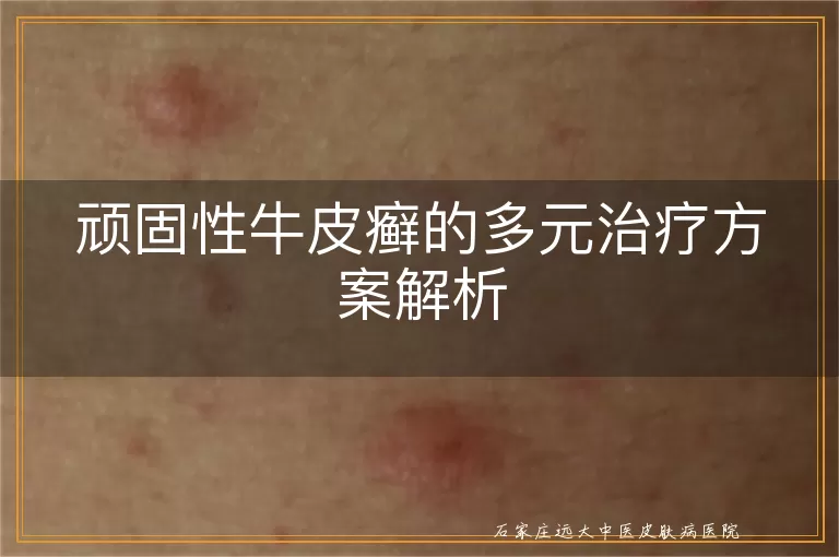 顽固性牛皮癣的多元治疗方案解析