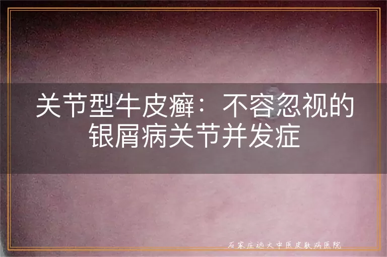 关节型牛皮癣：不容忽视的银屑病关节并发症