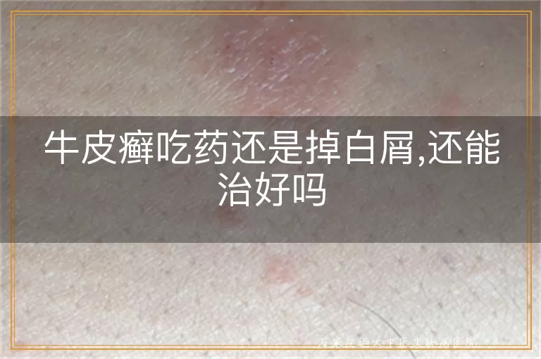 牛皮癣吃药还是掉白屑,还能治好吗