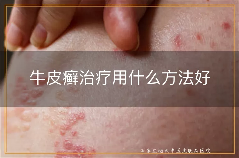 牛皮癣治疗用什么方法好