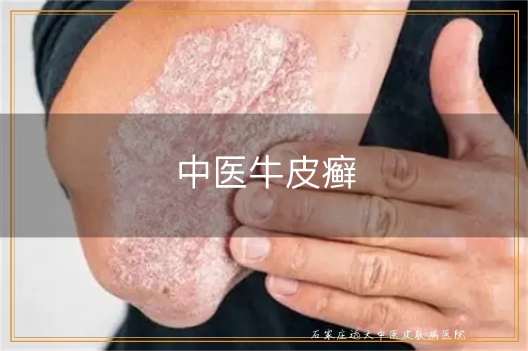 中医牛皮癣