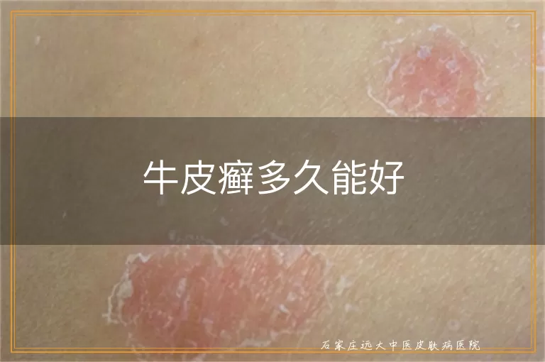 牛皮癣多久能好