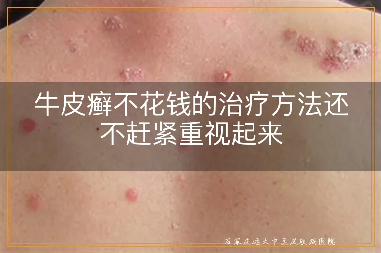 牛皮癣不花钱的治疗方法还不赶紧重视起来