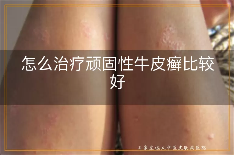 怎么治疗顽固性牛皮癣比较好
