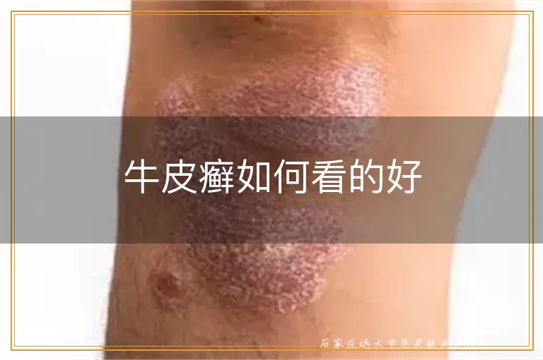牛皮癣如何看的好