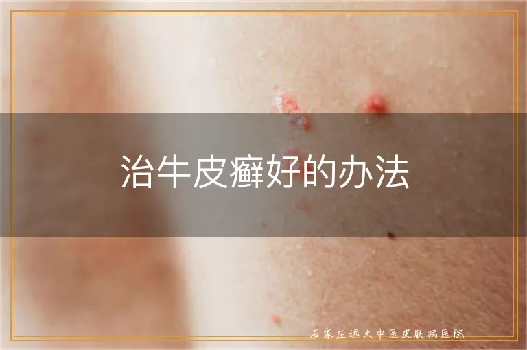 治牛皮癣好的办法