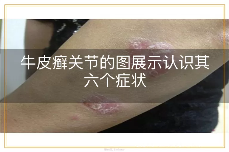 牛皮癣关节的图展示认识其六个症状
