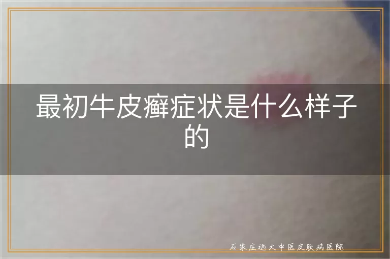 最初牛皮癣症状是什么样子的