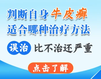 判断自身牛皮癣适合哪种治疗方法