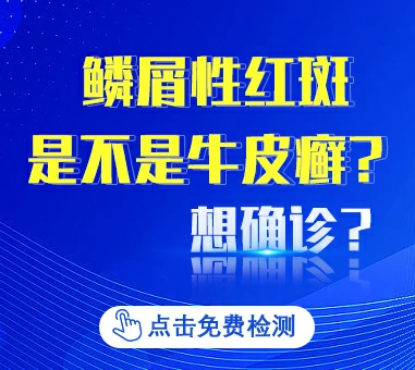 鳞屑性红斑是不是牛皮癣